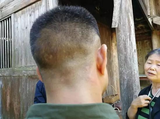 被蚊子咬了满头的大包.