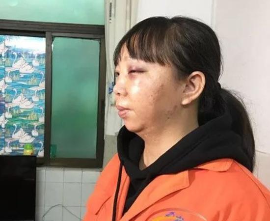 被打得满头肿包 他却说“幸亏打的是我”