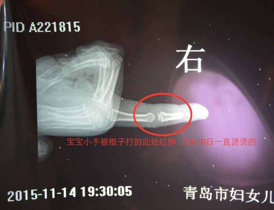 幼儿受伤照片