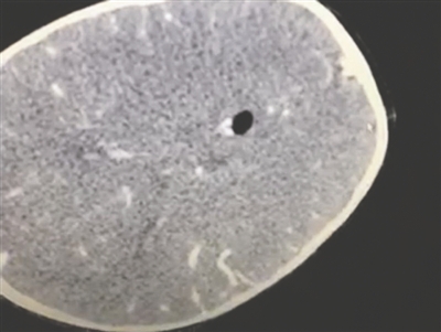 筷子插入颅内位置