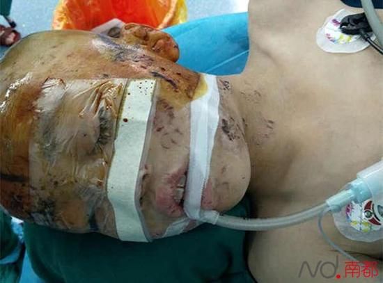 10岁的孩子经医生抢救后确认脑死亡。南都记者田飞摄