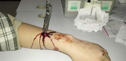 小伙跟风玩快刀游戏8厘米长刀插进手臂图