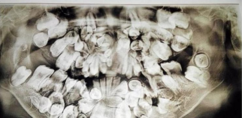 菲律宾中部宿雾省一名9岁男童长了约300颗牙齿。