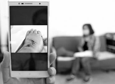 王丽（化名）的手被男乘客砍伤 新文化记者 李洪洲 摄 