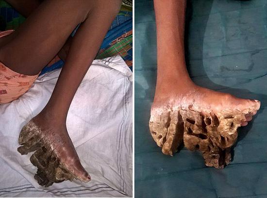 3姐妹患罕见先天皮肤病脚掌像老树皮图