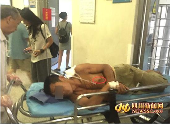 据医生介绍，钢筋刺穿都先生的左肩胛骨，贯通他的肺部，一直穿到他的前胸壁。在左先生的前胸能够看到突出的钢筋