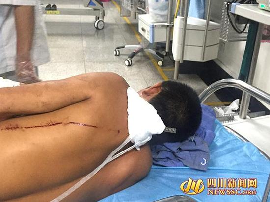 据医生介绍，钢筋刺穿都先生的左肩胛骨，贯通他的肺部，一直穿到他的前胸壁。在左先生的前胸能够看到突出的钢筋