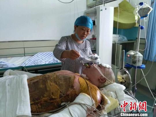 图为吴丽平喂儿子倪嘉俊吃饭。爆炸中，倪嘉俊全身烧伤面积达95%，目前四肢最为严重，生活无法自理。　范丽芳　摄