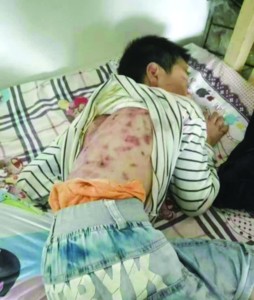 浑身伤痕的男孩(宁国网友供图)