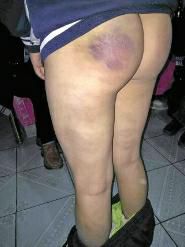 老师棍打屁股致青紫