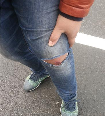 李先生受伤的腿