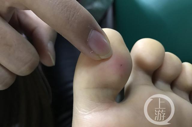 女孩住酒店被针扎伤脚趾缝衣针刺穿拖鞋鞋底