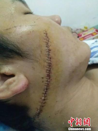 河北隆尧1名中学生遭刀割脸校长被警告处分