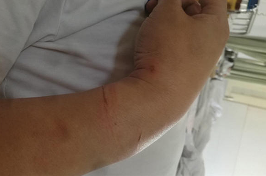 贾玉飞的手腕上留下的伤痕.