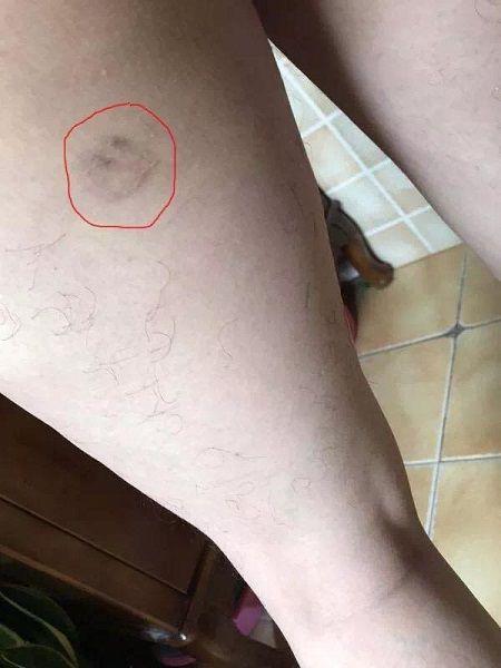 事情发生在去年底,虽然半年多过去了,腿上的疤痕仍清晰可见.