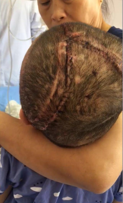 颅骨修复手术后,鹏鹏的头部留下两道明显的疤痕 受访者供图