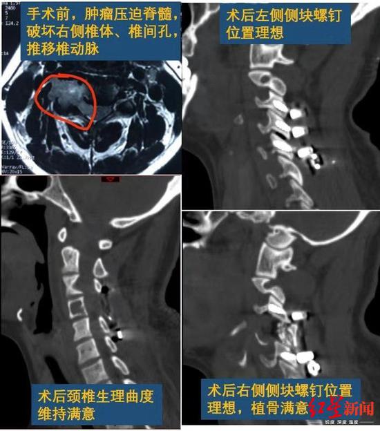 女子手麻头晕一查是颈椎里长个鸡蛋大肿瘤图