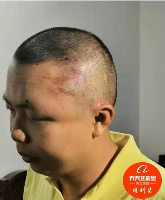 被打得满头肿包 他却说“幸亏打的是我”