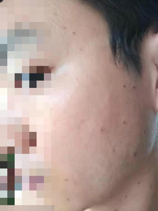 顾峰在美发店祛“疣”后脸上结痂。受访者供图