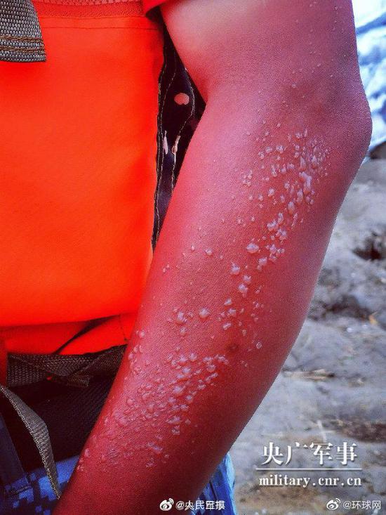 北青网综合|心疼！抗洪战士胳膊被晒出水泡