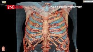 3D视频展示新冠患者肺部受损过程