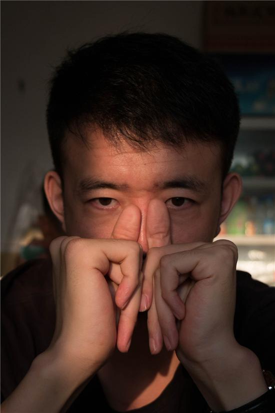 △ 2018年8月28日，北京市昌平区，苏佳宇在等待上菜过程中按揉鼻梁与眼睛。该病一大症状是眼部异常，部分存在晶体脱落状况。17岁时他因经常性睡眠呼吸骤停前去就医，后确诊为马凡综合征——一种发病率约 为1/3000~1/5000的罕见病。