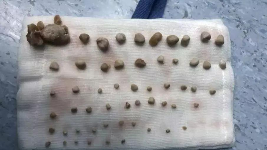 医生惊呼,这么小的年纪就有如此之多肾结石,实属罕见.家人称