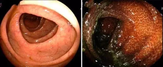 肠镜下,正常的肠道(左)和结肠黑变病肠道对比