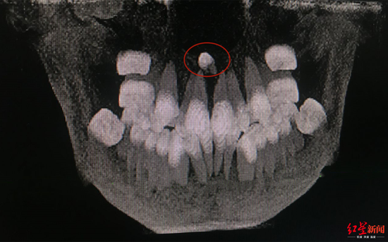 牙齿x光片报告单图片