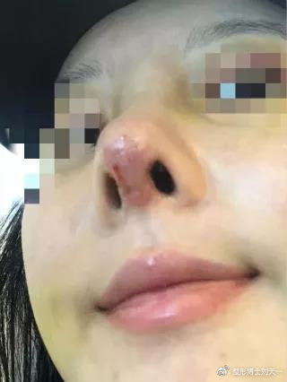 图:鼻小柱皮肤坏死