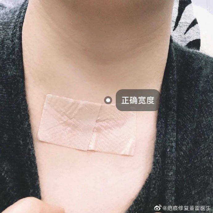 疤痕贴(美皮护)正确用法:合适宽度很重要!据瘢痕大小进行剪裁,建议边缘宽度超过瘢痕1cm左右!如果疤痕面积较大也可以拼接,拼接时注意拼接平整。