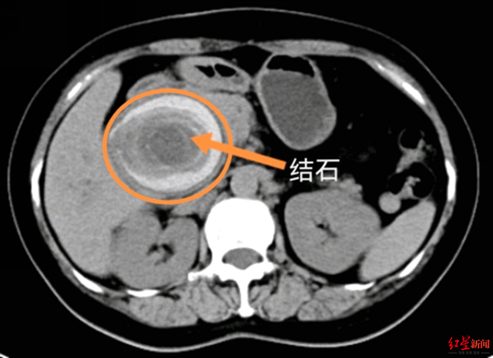 肝内胆管结石彩超图片图片