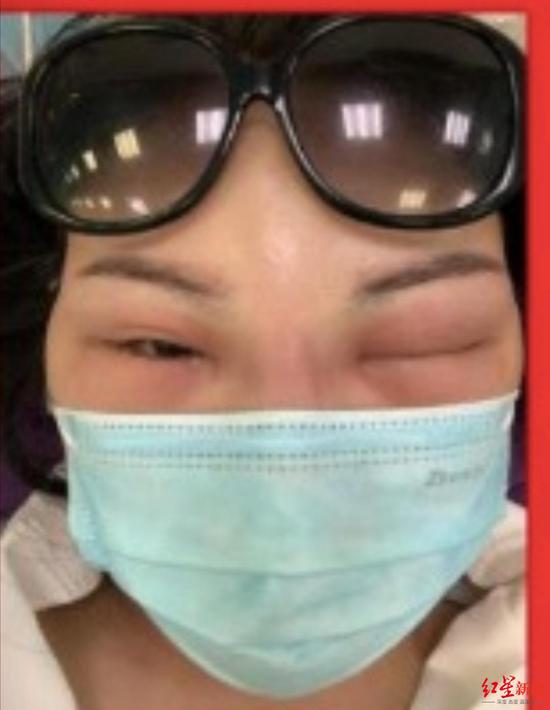 女子注射玻尿酸后称有异物残留致面部多次肿大