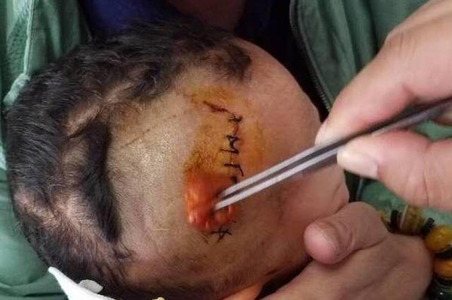 广元3岁小孩小区内被狗咬头缝10针 父亲气愤将狗打死