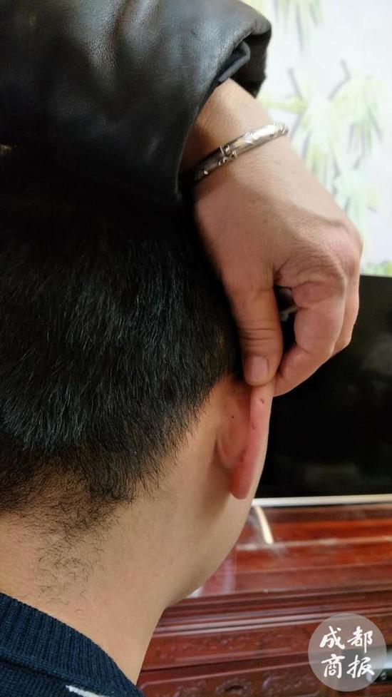 四川小伙3岁被拐22年后母亲凭耳廓上3个凹坑认出他