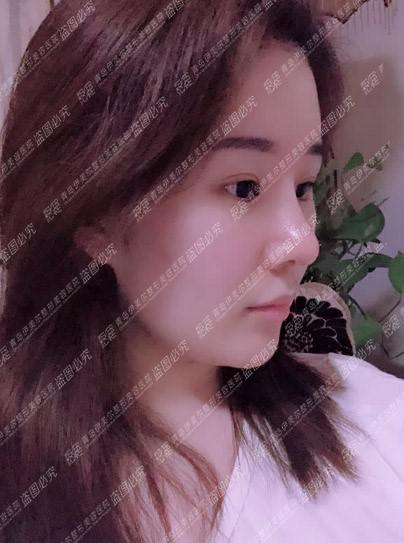 在青岛伊美尔做的鼻子,韩式小翘鼻年轻又自然