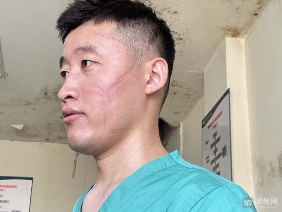 在定点救治医院,医护人员摘下口罩,脸上满是勒痕.