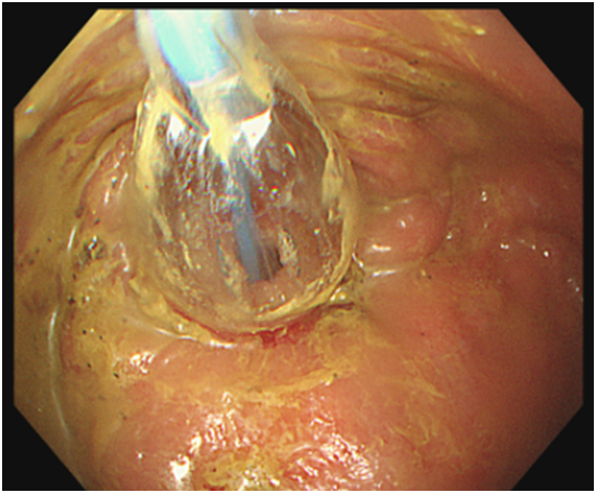 宁津县人民医院内镜中心开展首例内镜下肠道狭窄球囊扩张术