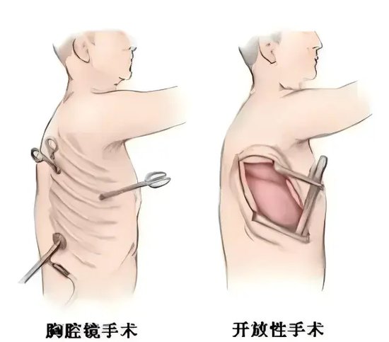 目前,主流的胸部手术技术,早已从开胸大手术发展到以腔镜为主的微创