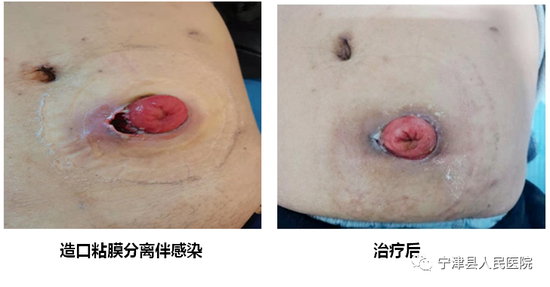 宁津县人民医院外科门诊换药室:专业护理暖人心 造口护理获称赞