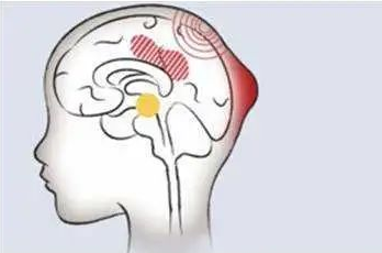 德州市第七人民医院多学科团队成功救治一例重型颅脑损伤患者!