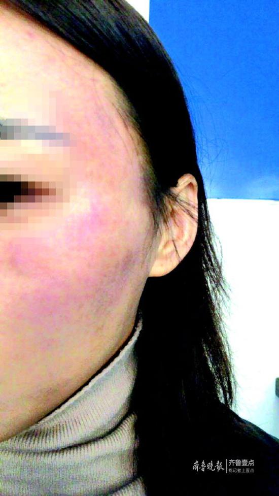 打了玻尿酸 成了"歪歪脸" 菏泽一爱美女子遇愁事