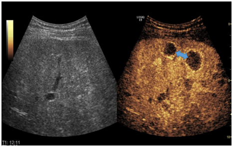 德州首例德州市第二人民医院超声造影照出肝脏肿瘤真面目