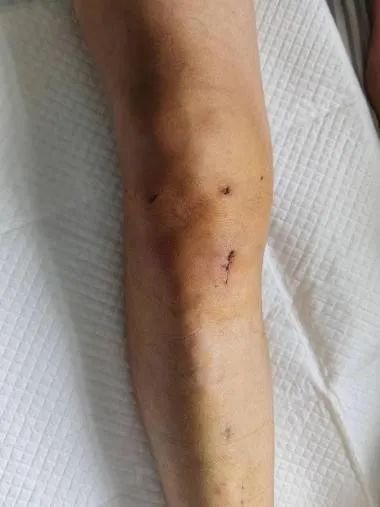 手术切口术后影像术后影像微创外科又称为"钥匙孔手术",是当今世界