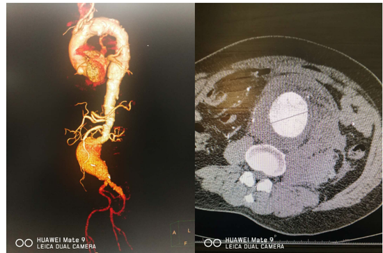 菏泽市立医院心血管外科团队成功抢救破裂性腹主动脉瘤一例