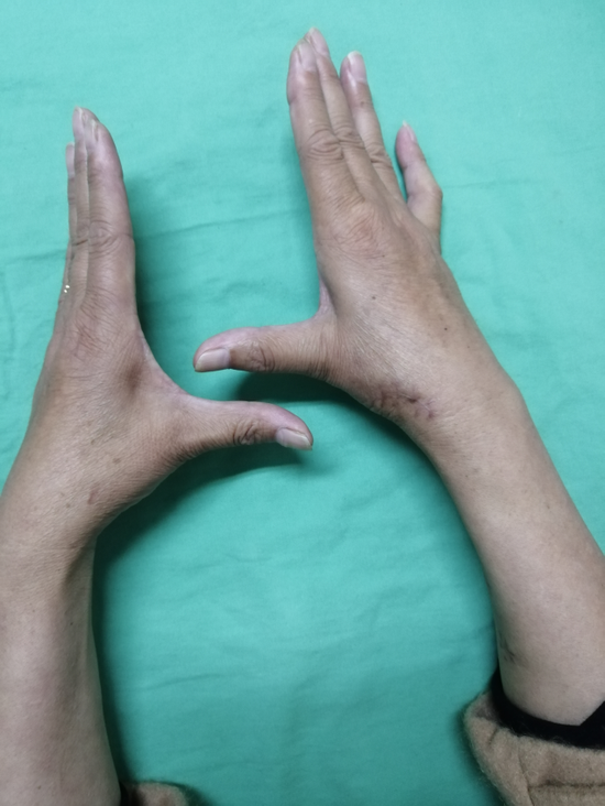 术后外观及功能情况2术后外观及功能情况3拇腕掌关节炎是骨关节炎最