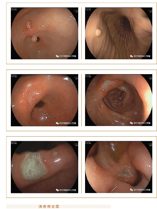 上皮内瘤变是由什么造成的 2e68-93eff5816b9fded96bec6c25818f678e.png