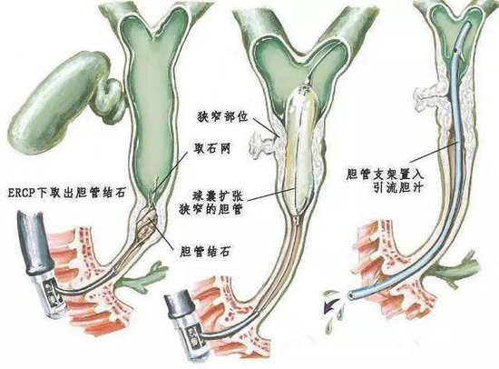 ercp行胆道取石术及胆管支架引流术示意图