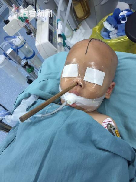 幼童玩耍跌倒20cm筷子直插大脑 上海医生连夜抢救