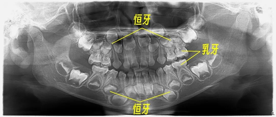 5岁孩子的口腔全景片(影像放射科 邓志强医师提供)